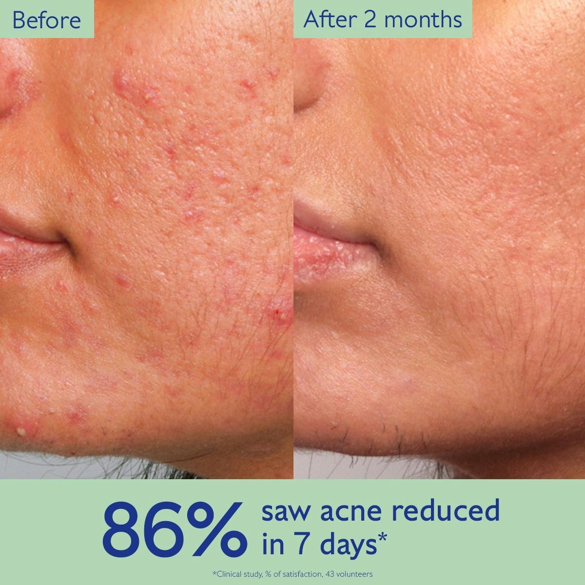 Acne-Prone Skin Essentials