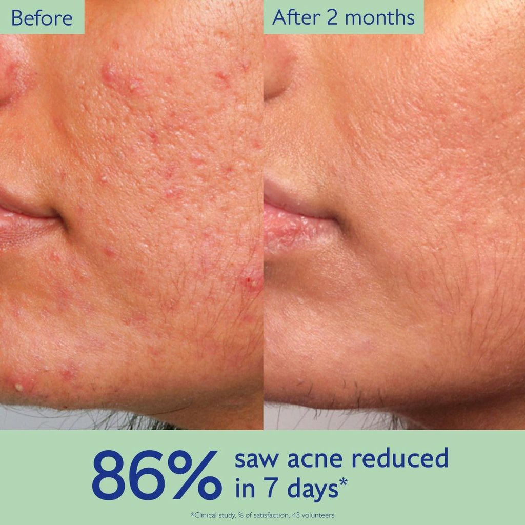 Acne Serum to Treat and Prevent Blemishes